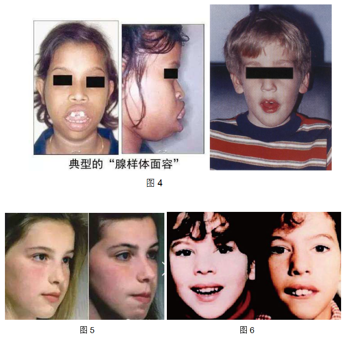 喉软骨软化,多见新生儿,随着发育的成熟逐渐缓解.